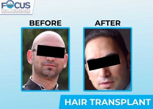 Topmost Centre for Hair Transplant in Punjab