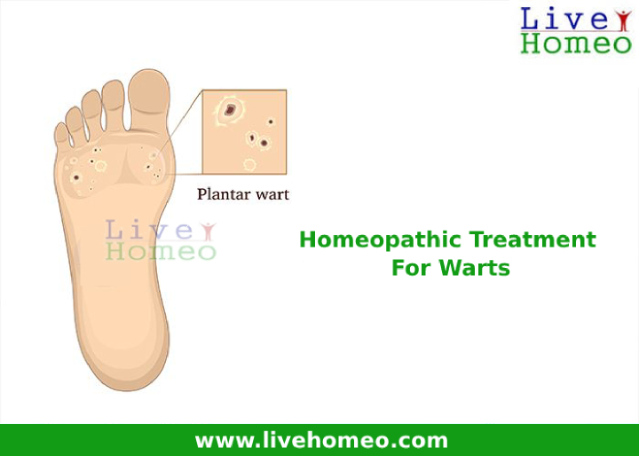 Effective Homeopathy Treatment For Warts