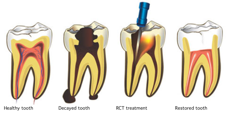 Affordable Root Canal treatment in Pune