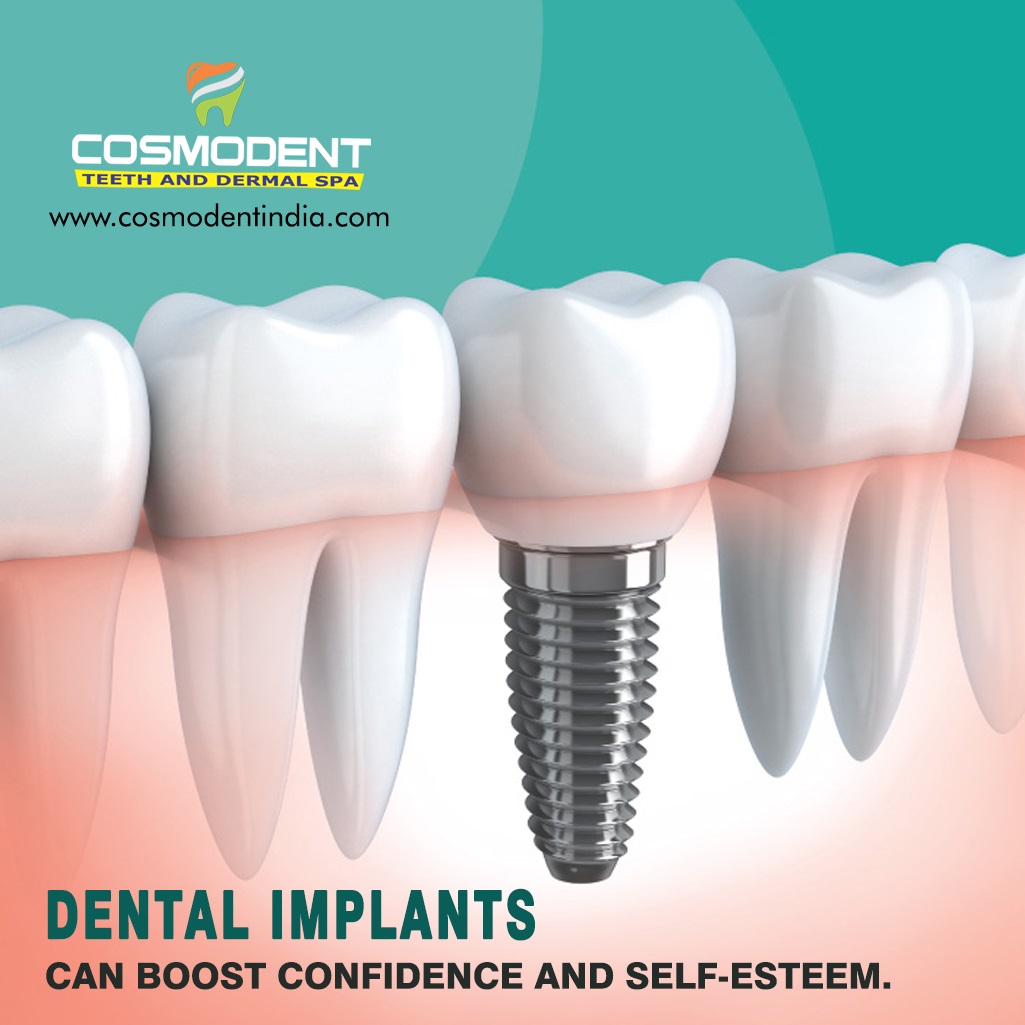 All On 4 Dental Implants Cosmodent India