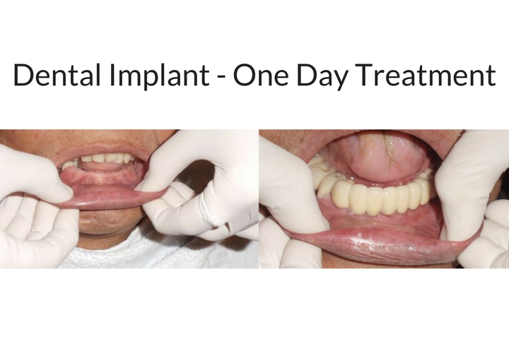 Dental Implants center in Mumbai