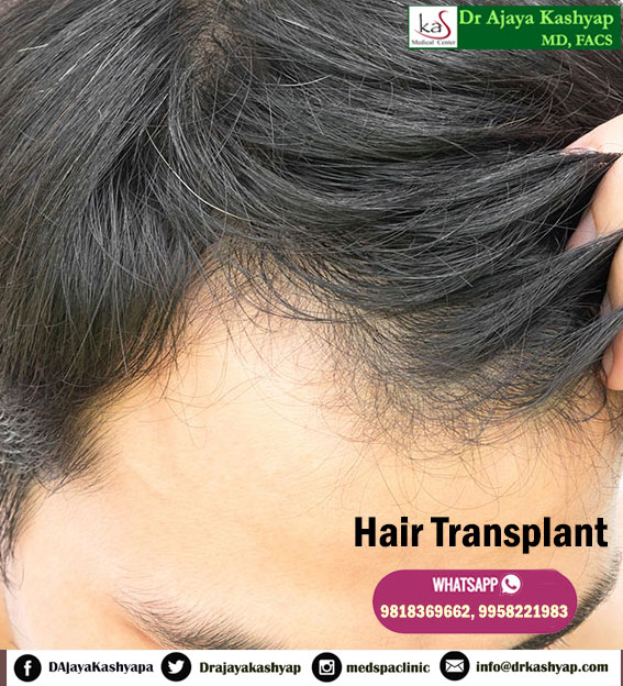 Hair Transplantation Clinic in Delhi