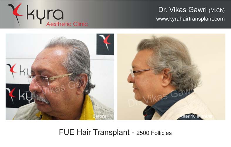 Fue Hair Transplant in India